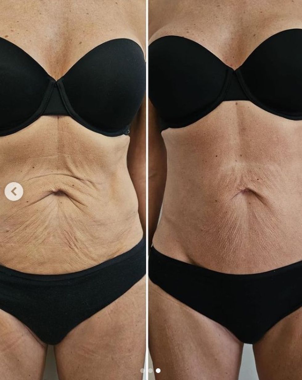 Antes y después del tratamiento tensor de la piel.