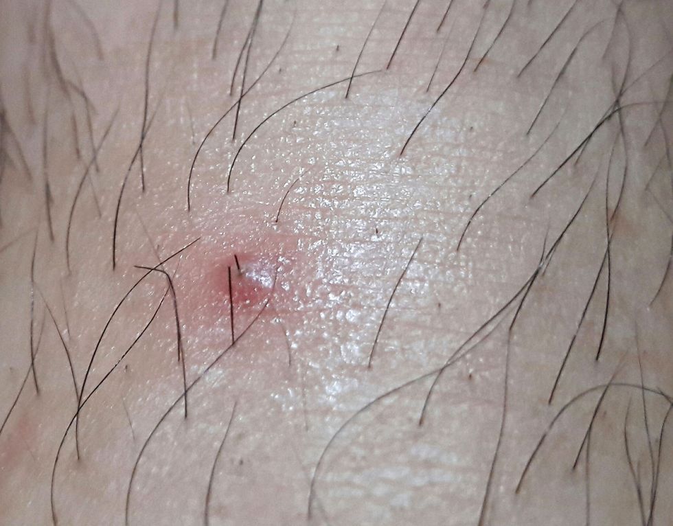 Cómo deshacerse del cabello en la coronilla una persona con piel clara y una marca roja e hinchada con una pústula blanca