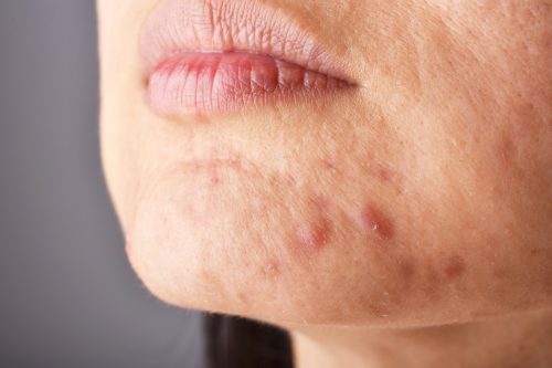 Primer plano del rostro de una mujer con acné
