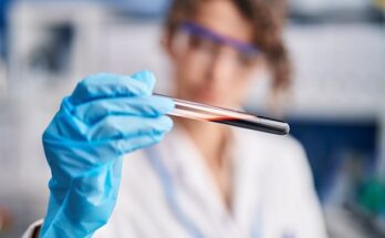 Un análisis de sangre simple puede determinar si los pacientes avanzarán la mayor de Alzheimer, para revelar el estudio