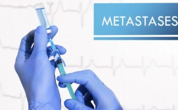 Gene Expression Profiling of Breast Cancer Brain Metastases – Mirrors of Medicine
