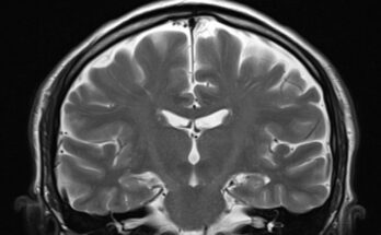 An MRI scan of a human brain