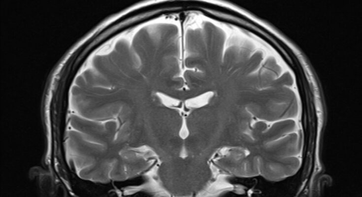 An MRI scan of a human brain