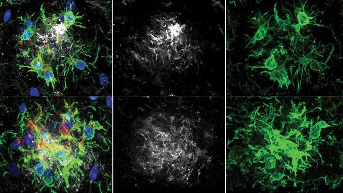 Los investigadores dijeron que cuando se eliminó la proteína PTP1B del cerebro del ratón, como se muestra en la fila inferior, el tejido cerebral (verde) era mejor que las placas de beta amiloide (gris), como se muestra en el panel izquierdo.